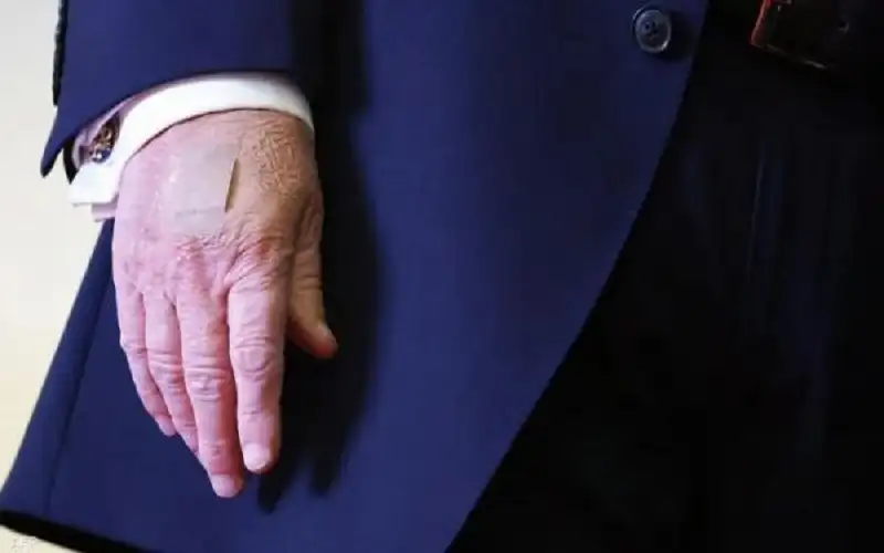 ضمادة على يده ترامب تثير التساؤل؟