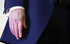 ضمادة على يده ترامب تثير التساؤل؟