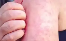 الstrongصحةstrong الأمريكية تحذر من تفشي الحصبة