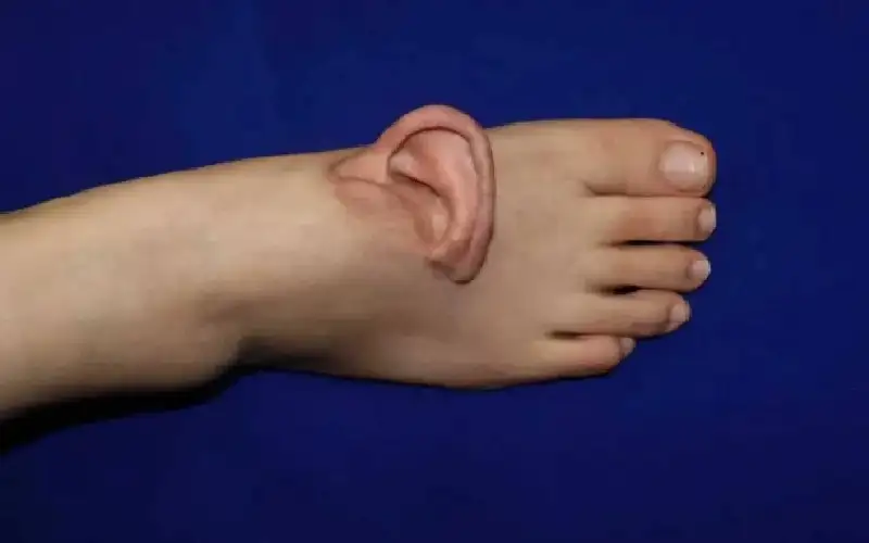 أذن في القدم.. قصة الجراحة التي