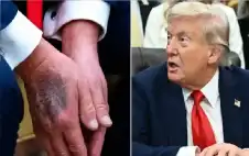 صحة ـ بعد اعتراف ترامب المثير.. أطباء يكشفون