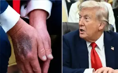 صحة ـ بعد اعتراف ترامب المثير.. أطباء يكشفون