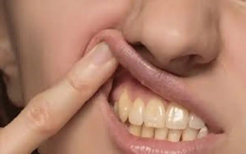 ابتكار جديد لوقاية الأسنان من التسوس