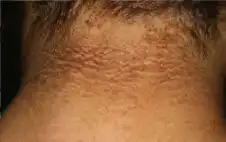 صحة ـ الشواك الأسود.. جرس إنذار لاضطراب خطير