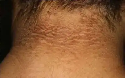 صحة ـ الشواك الأسود.. جرس إنذار لاضطراب خطير