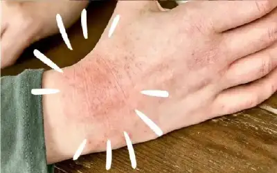 هل تشكو من إكزيما الشتاء؟ إليك