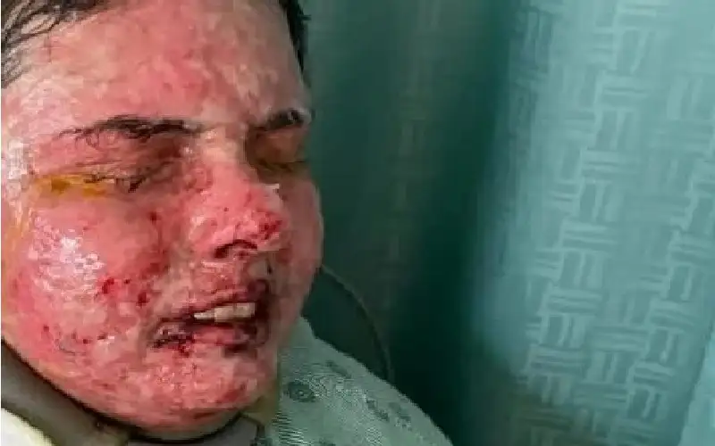 خسرت جلدها وعينيها.. دواء شائع يحرق
