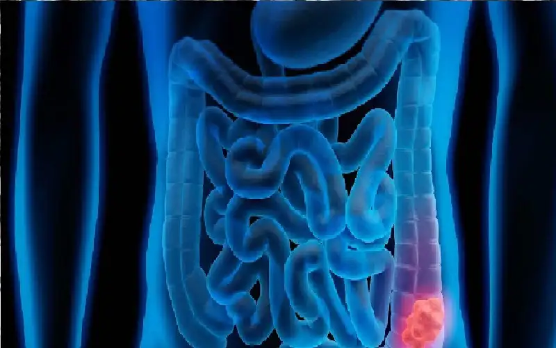 سرطان القولون يفتك بالأمريكيين دون سن