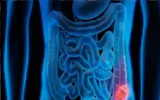 صحة ـ سرطان القولون يفتك بالأمريكيين دون سن