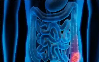 صحة ـ سرطان القولون يفتك بالأمريكيين دون سن