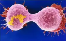 سرطان الثدي.. كيف يكتشف الذكاء الاصطناstrongعيstrong