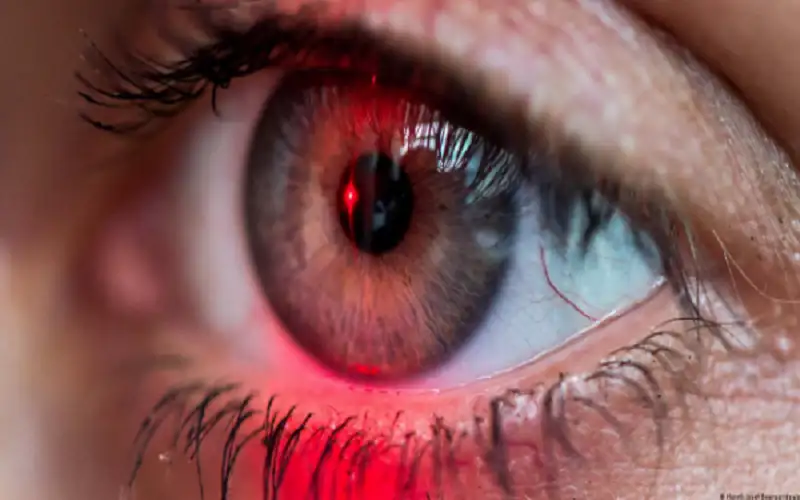 بكتيريا في العين قد تنذر مبكرا