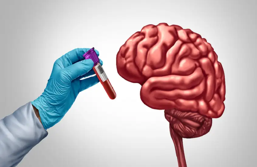 أدوية شائعة لهشاشة العظام تحمي الدماغ