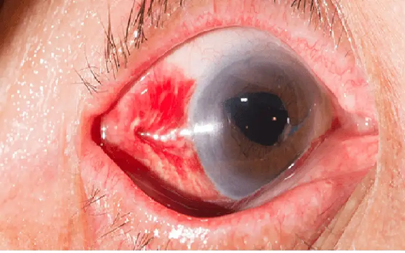 سكتة العين تهدد مستخدمي حقن التنحيف..