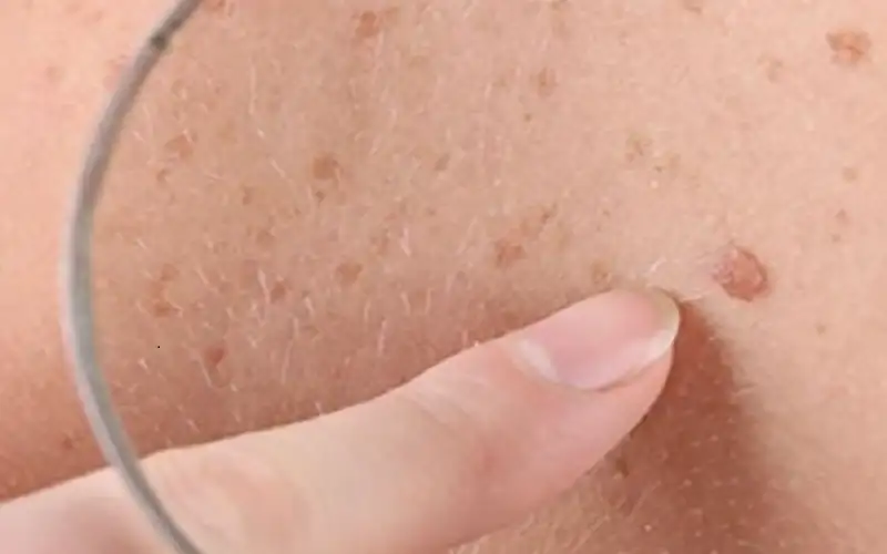 روسيا تبدأ استخدام أول لقاح لعلاج