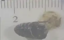 لغز طبي.. سعال أنفي يخرج ديدانا