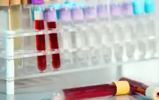 اكتشاف علامة مبكرة خفية للإصابة بالسرطان