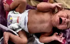 جدري الماء.. من بثور عابرة إلى