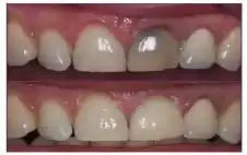 أسباب تغير لون الأسنان وطرق استعادة