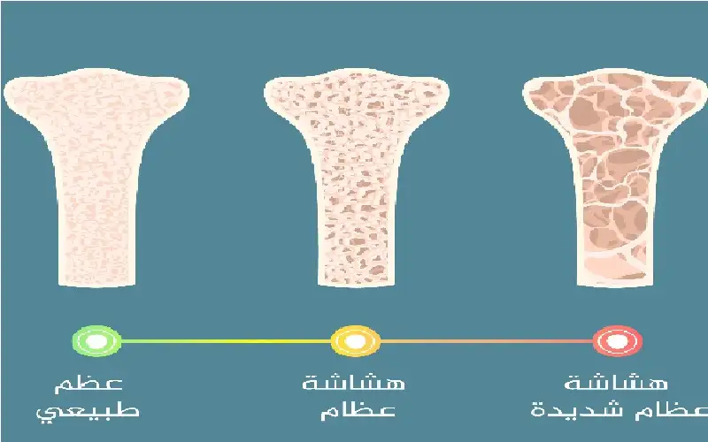 دور مهم للعلاج الهرموني في حماية