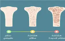 دور مهم للعلاج الهstrongرمstrongوني في حماية