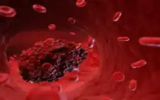 عادات strongيوميةstrong تزيد خطر الجلطات