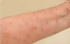 ما هو مرض سكابيوس الجلدي وكيف