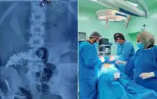 استخراج 214 إبرة ودبوسا من بطن