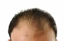 صحة ـ 36 شعرة إضافية لكل سنتيمتر مربع..