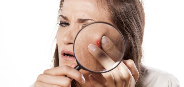 تخلصي من البقع البنية وندوب حب