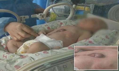 بالفيديو.. لحظة مؤثرة لطفل ولد بقلب