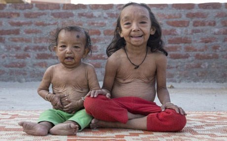 طفلان يعانيان من مرض نادر اصابهما