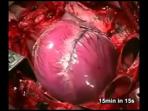 شاهد ماذا يحدث في القلب لحظة