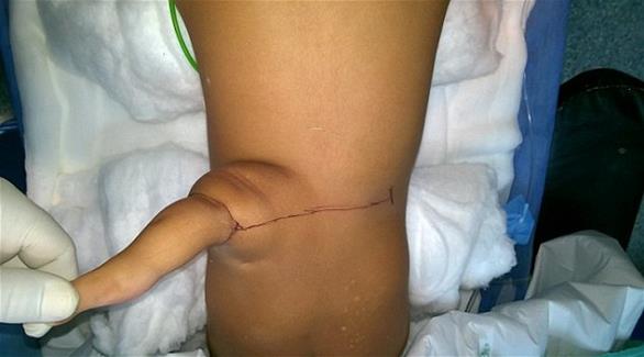 طفلة تولد بـ (ذيل) يتدلى من
