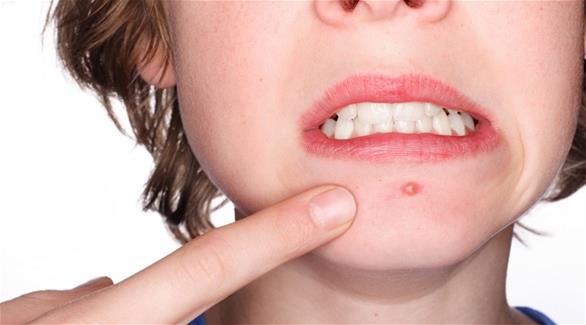 7 وسائل تحميك من ظهور البثور