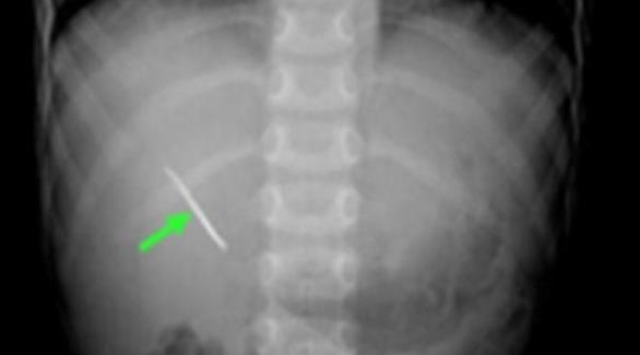 أغرب جراحة لطفل سعودي بلع (دبوس