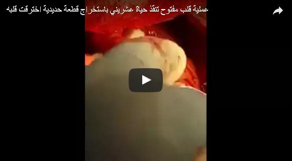 بالفيديو: إنقاذ مريض اخترقت قلبه قطعة