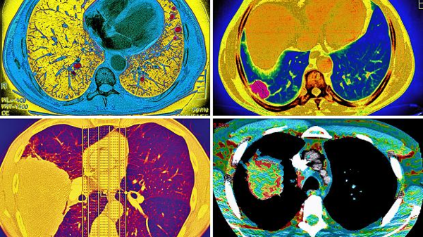 اختراق ثوري يتوعد السرطان بتدمير خلاياه