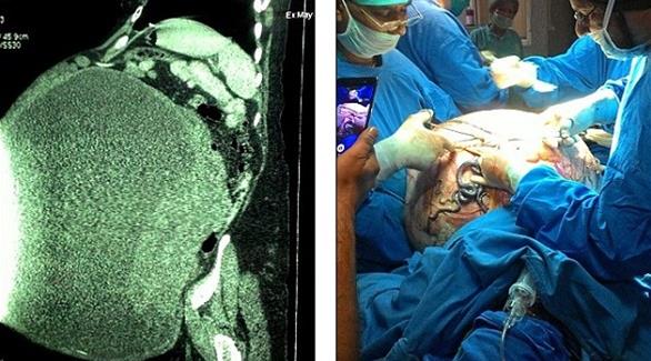 بالصورة: استئصال ورم سرطاني بحجم فيل