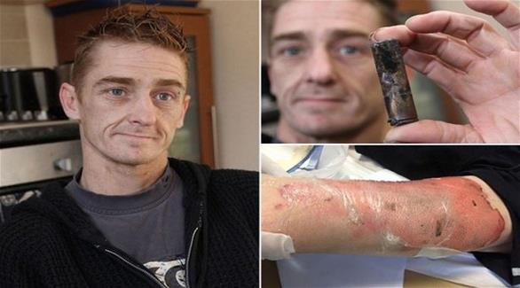 تعرض لحروق شديدة بعد انفجار سيجارة