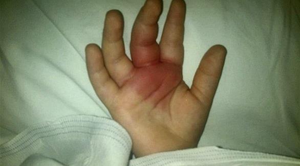 لدغة عنكبوت تشل طفلا في الثانية