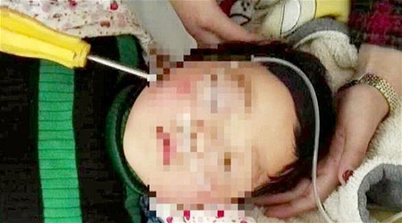 نجاة طفلة من الموت بعدما اخترق