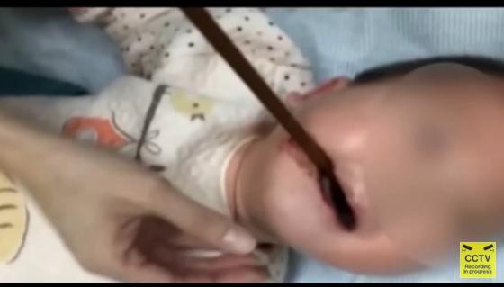 بالفيديو: إزالة عصا اخترقت حلق رضيع