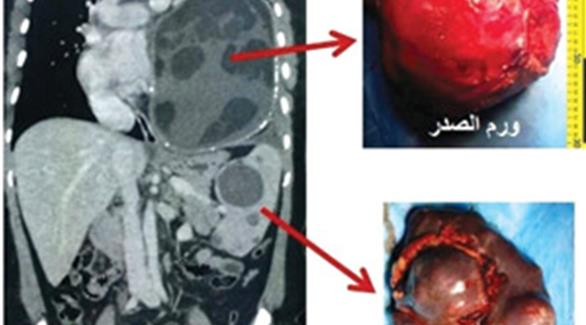 استئصال ورم بحجم كرة قدم من